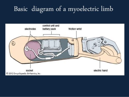 myoelectric-prosthesis-7-638